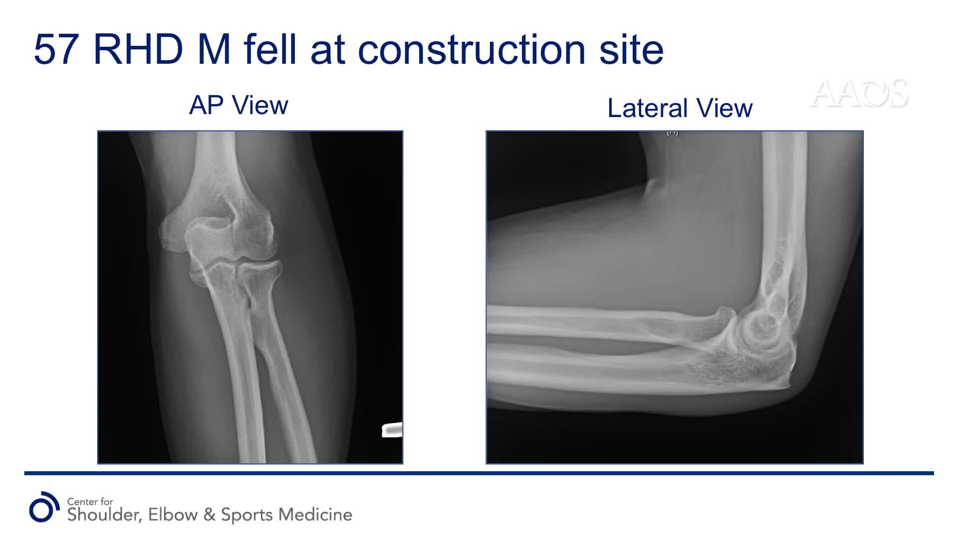Suture Repair of Distal Triceps Rupture with anAnatomic Transosseous Cruciate Construct