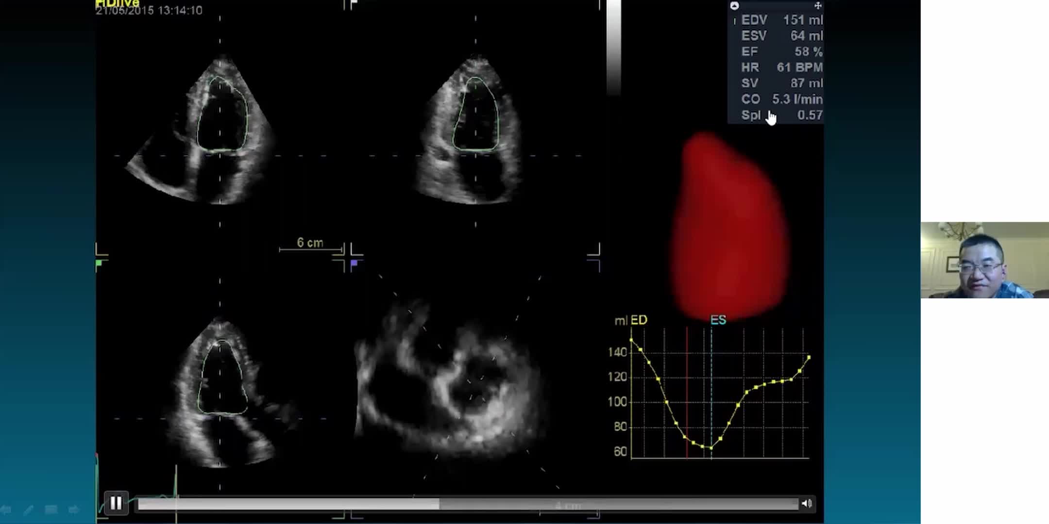 左室定量分析与超声诊断在休克评估中的应用
