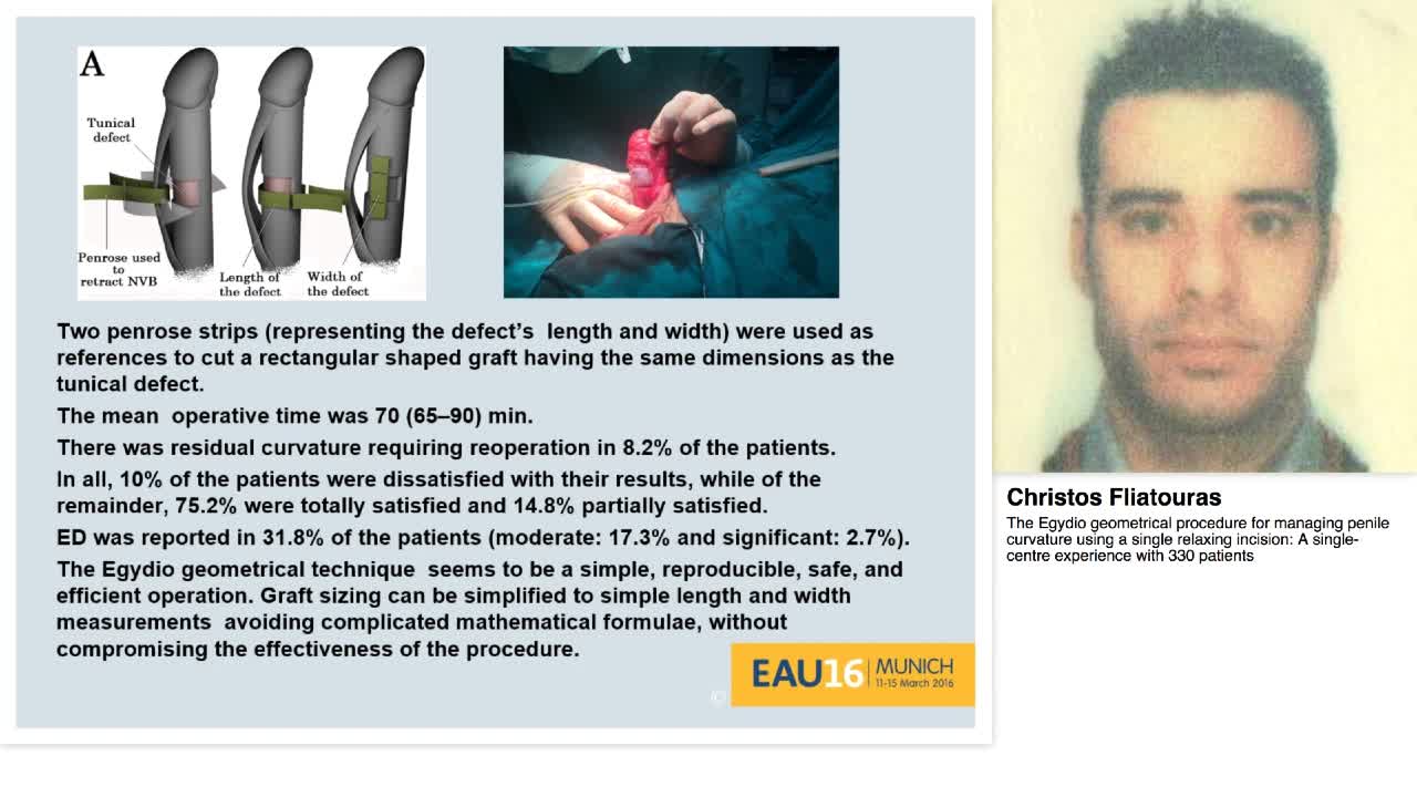 The Egydio geometrical procedure for managing penile curv-