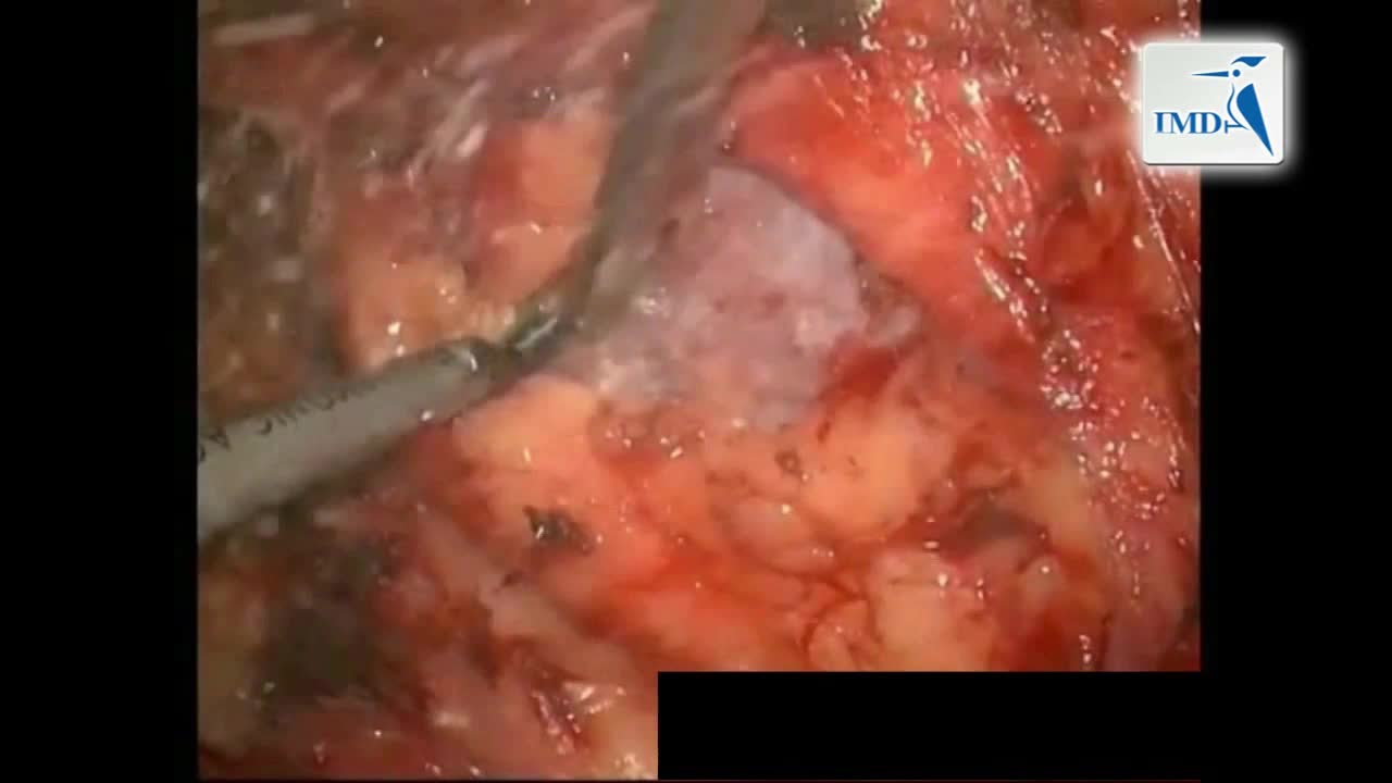 腹腔镜肾部分切除术中的新技术