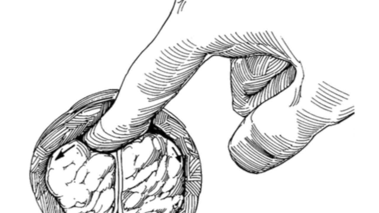 Comparison between en-bloc and 3 lobes HoLEP techniques