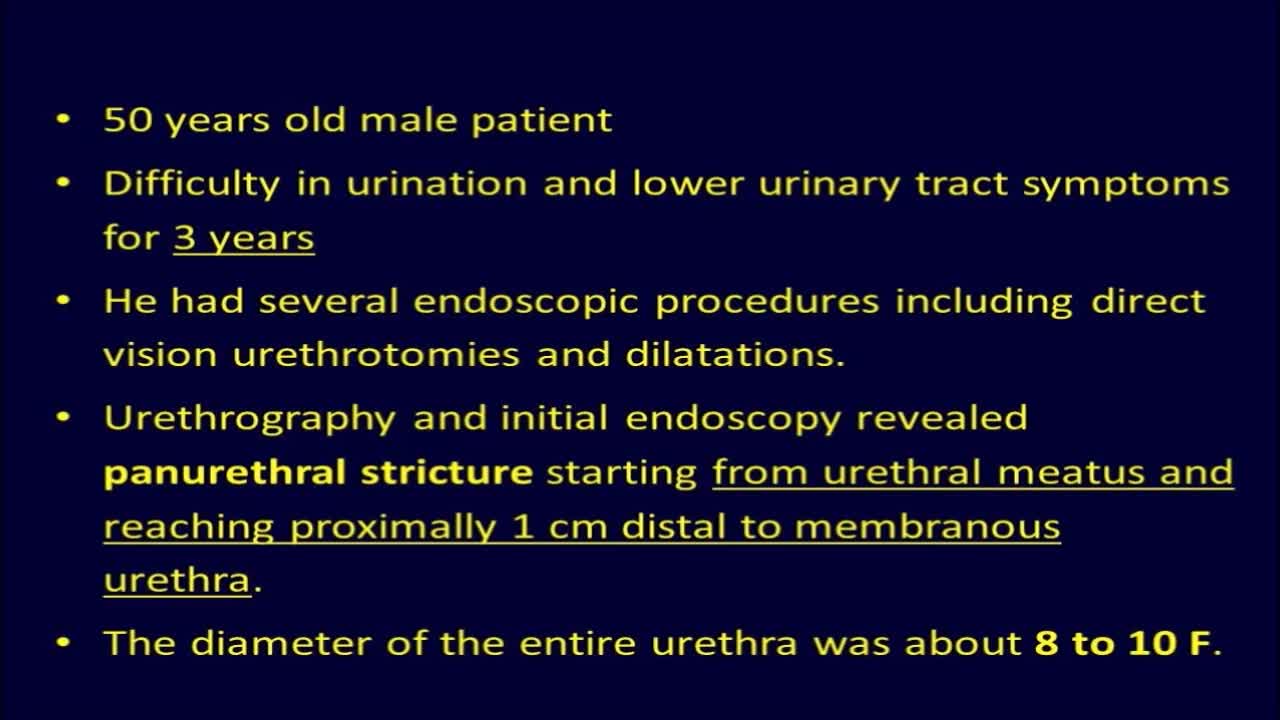 Single session urethroplasty with bilateral buccal mucosa..-