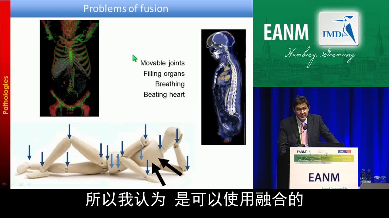 PET和MR 在软组织肉瘤诊断治疗中的作用（4）