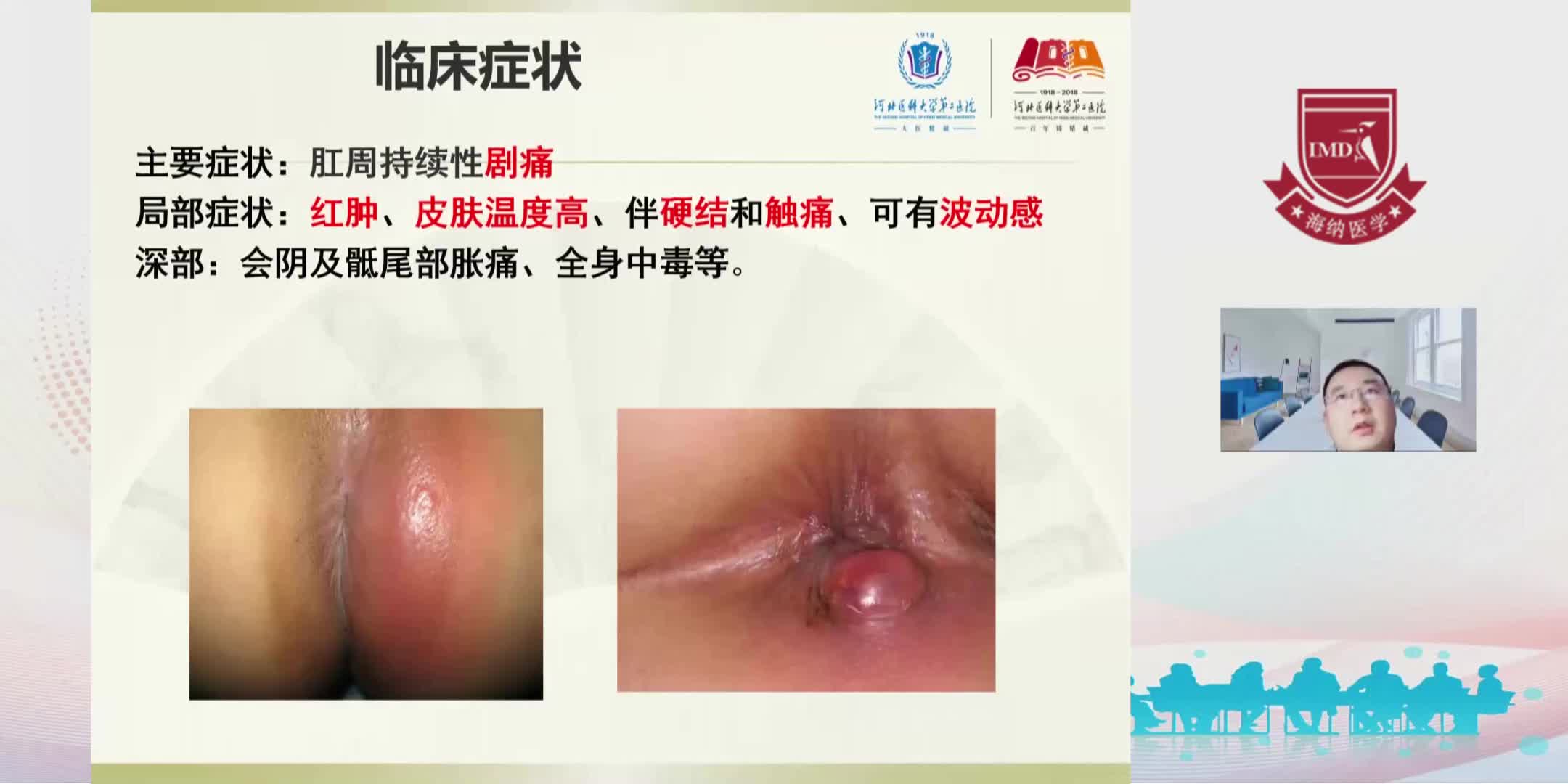 李猛--肛周脓肿1