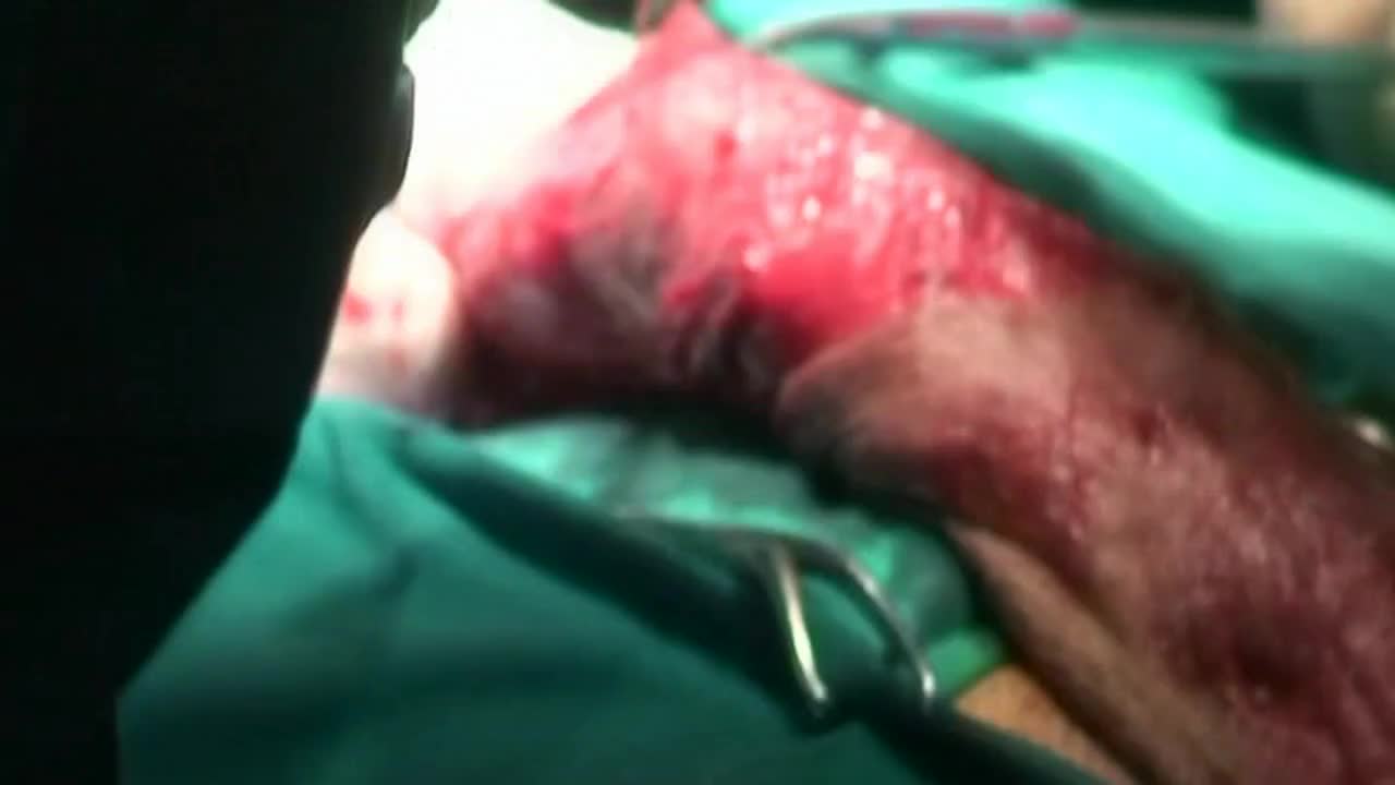 V16 - The use of tunica vaginalis as a graft on the corporal he..-