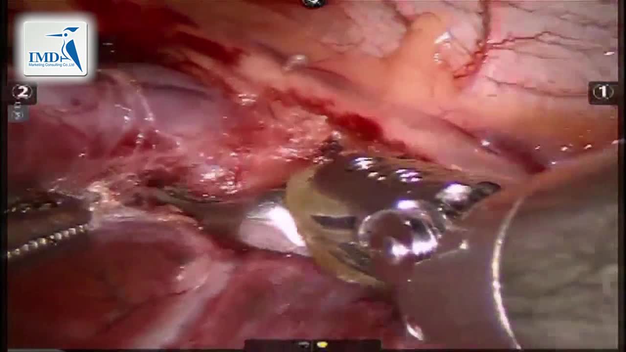 机器人辅助肺切除手术（2）