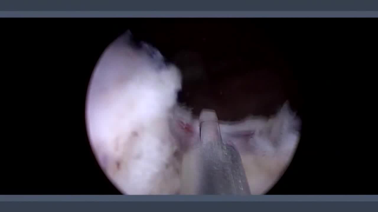 HoLEP (holium laser enucleation of the prostate) - tips &..-