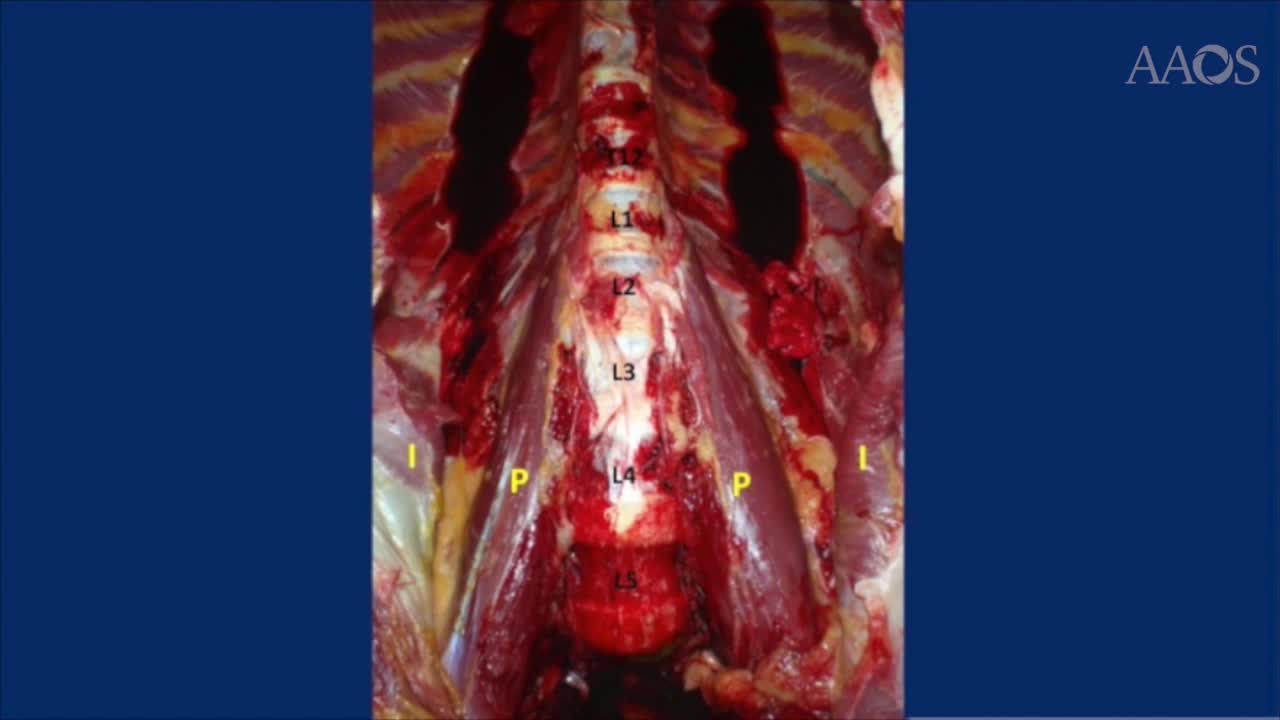 INTERNAL SNAPPING HIP FROM ANATOMY TO ENDOSCOPIC RELEASE