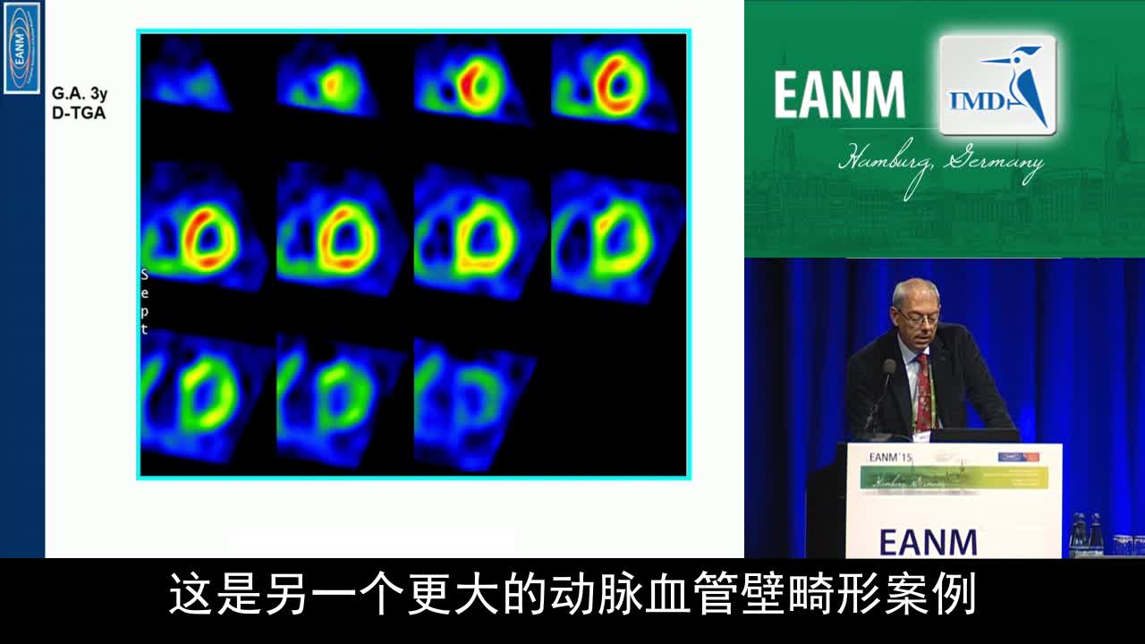 儿科心脏病学中的心肌分子造影（4）
