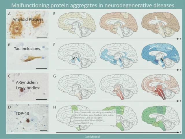 Nilotinib improves motor skills, cognition and autonomic function in open label phase I Parkinson's disease with Dementia and Le