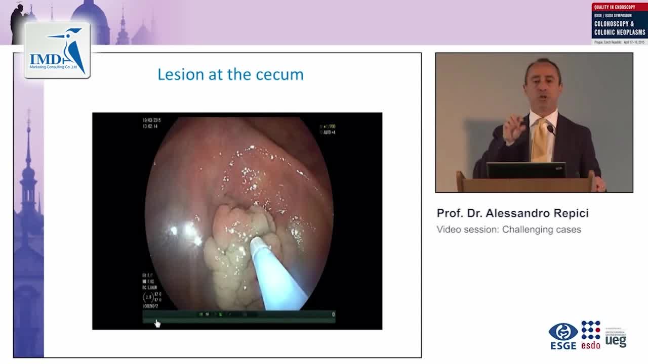 息肉切除术的挑战（3）