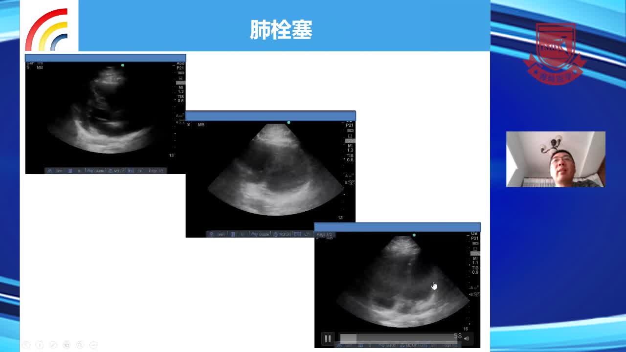 床旁超声助力心肺复苏--尚游（4）