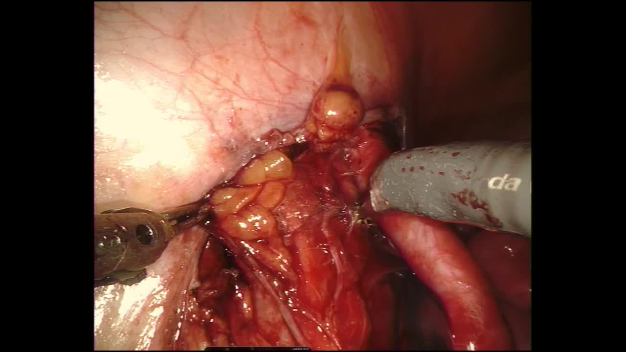 Robotic kidney transplantation with transvaginal graft in..-