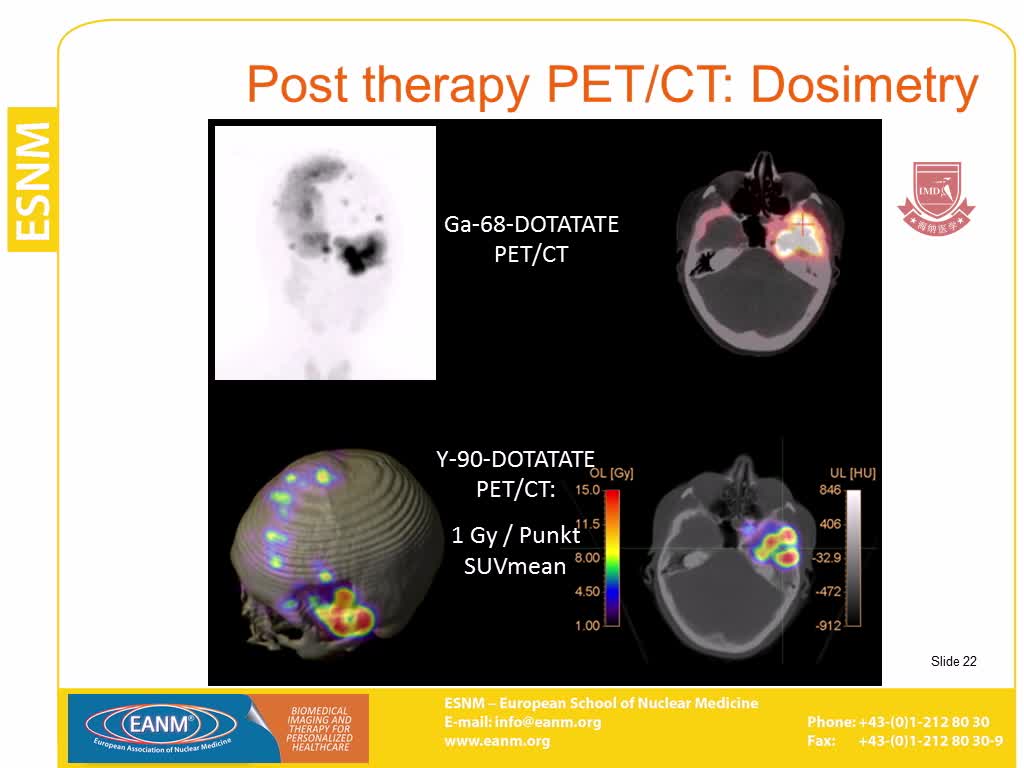 PET CT用于计划和监测放射性核素治疗方案4