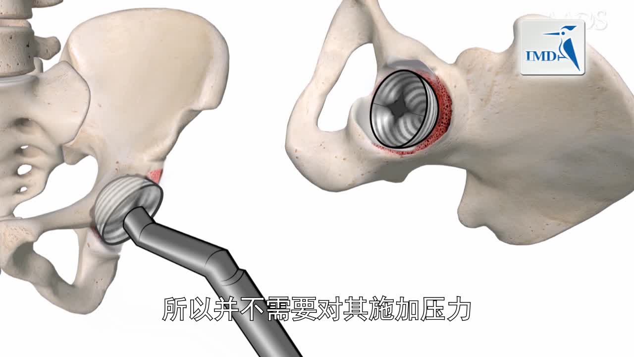 微创直接前部方式下的髋臼假体修正（3）
