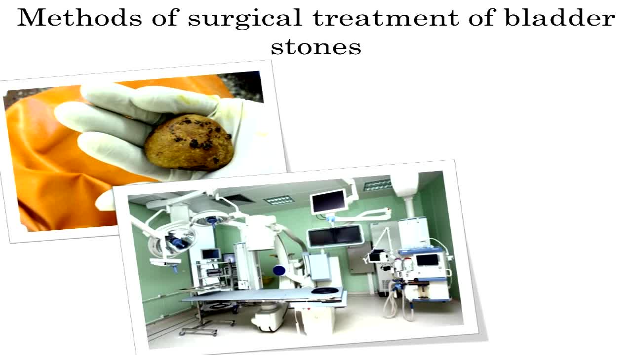 Transurethral contact cysto- and ureterolithotripsy in a ..-