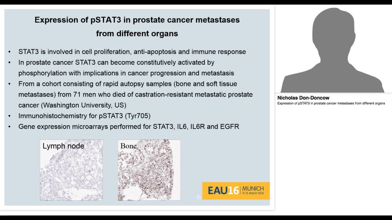 Expression of pSTAT3 in prostate cancer metastases from d-
