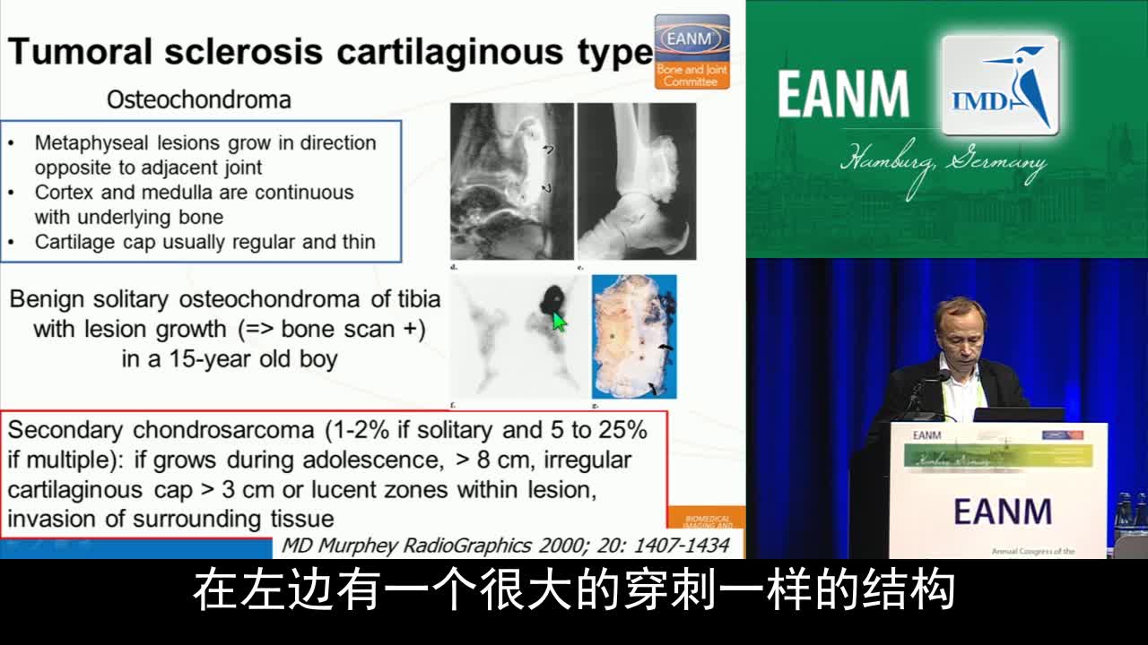 内生软骨瘤,软骨骨瘤,内生软骨肉瘤：多模态影像挑战（2）