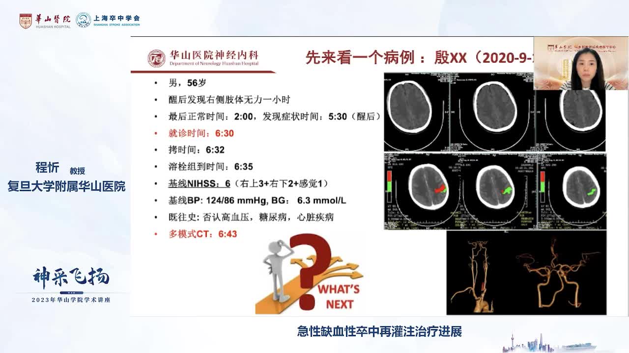 程忻-急性缺血性卒中再灌注治疗进展