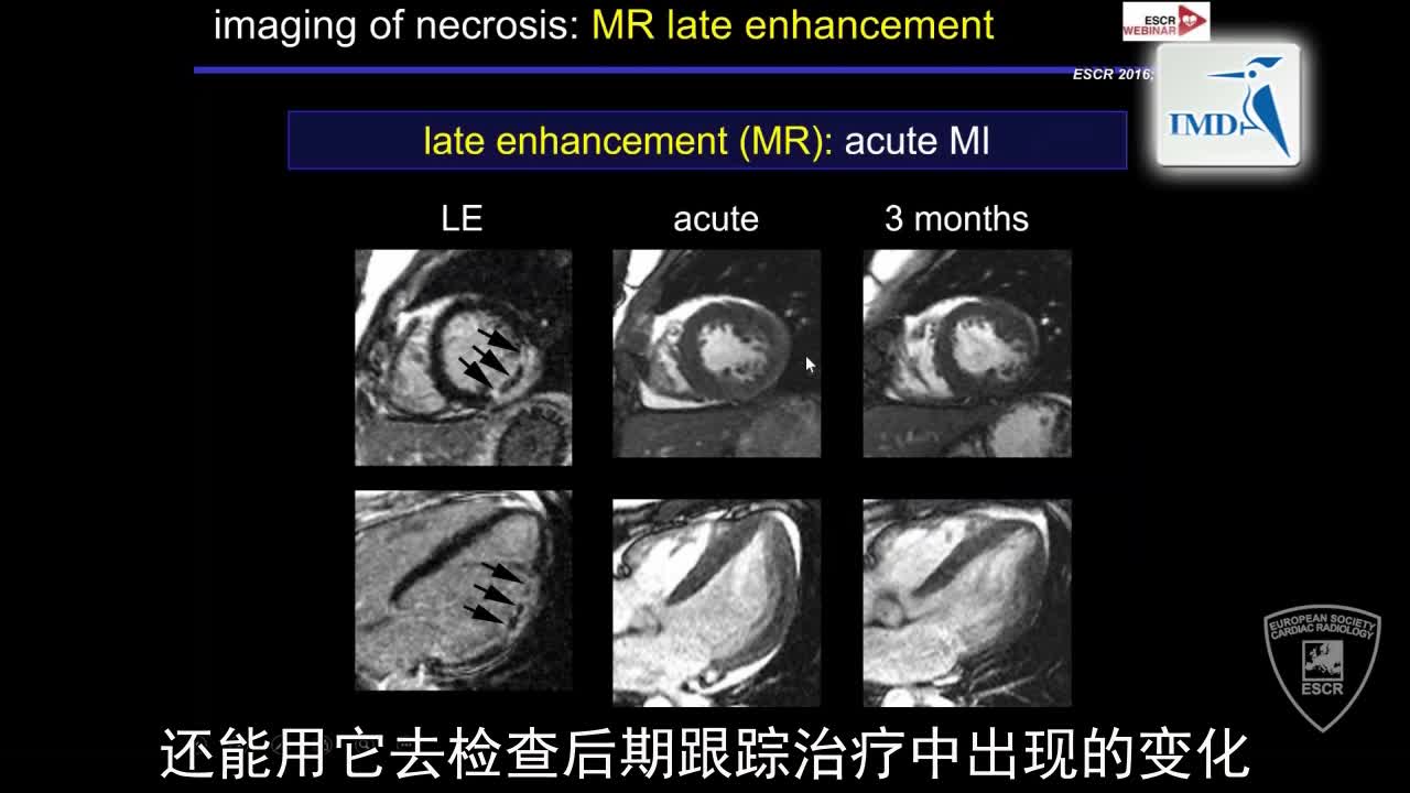 急性冠状动脉综合征发作后的影像诊断（8）