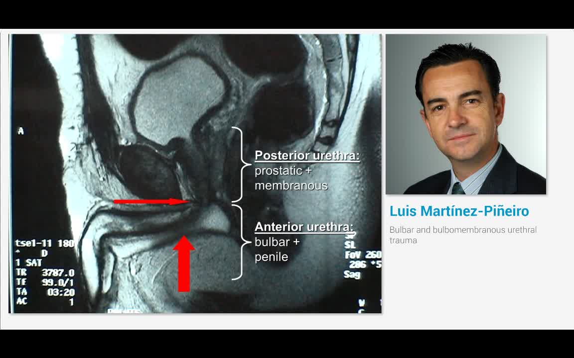 Bulbar and bulbomembranous urethral trauma