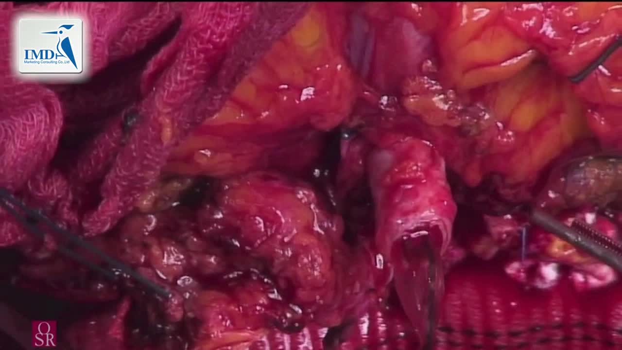 胸腹部主动脉瘤开放性修复术