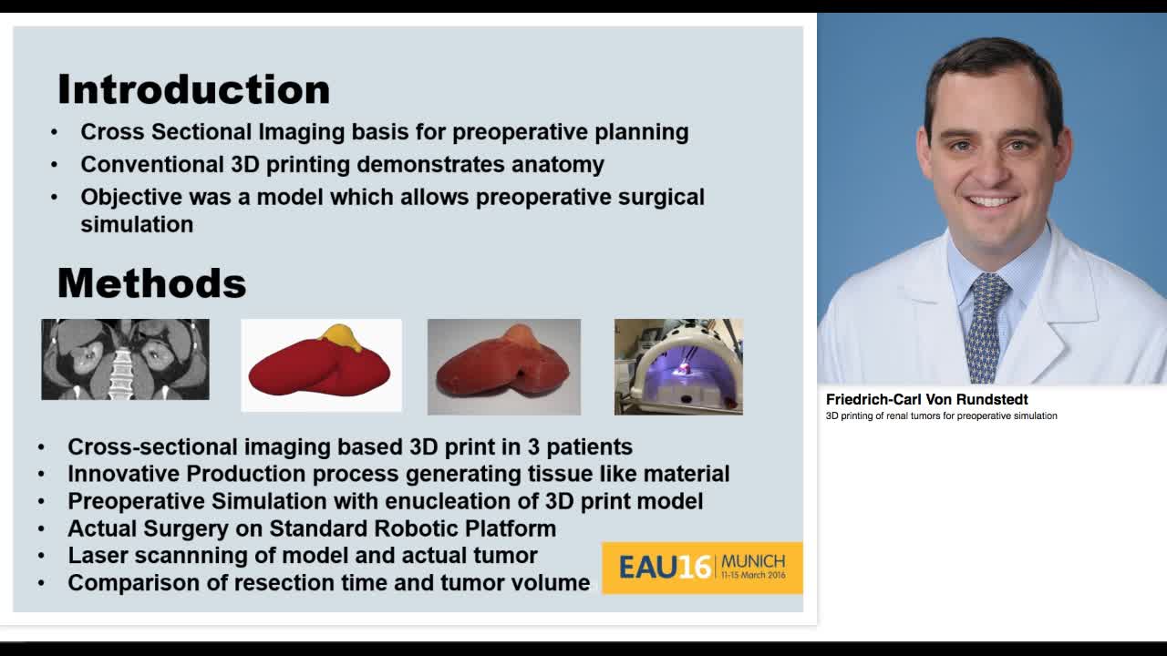 3D printing of renal tumors for preoperative simulation