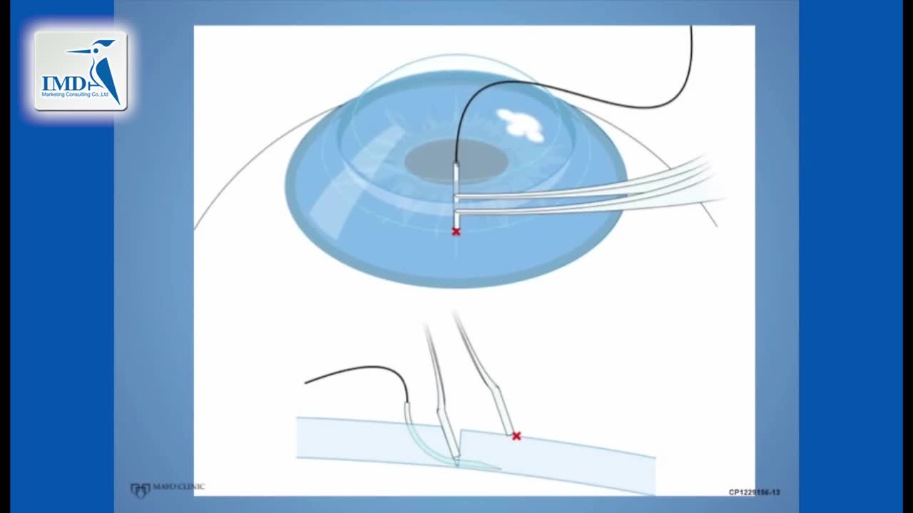 角膜缝合手术操作步骤（4）