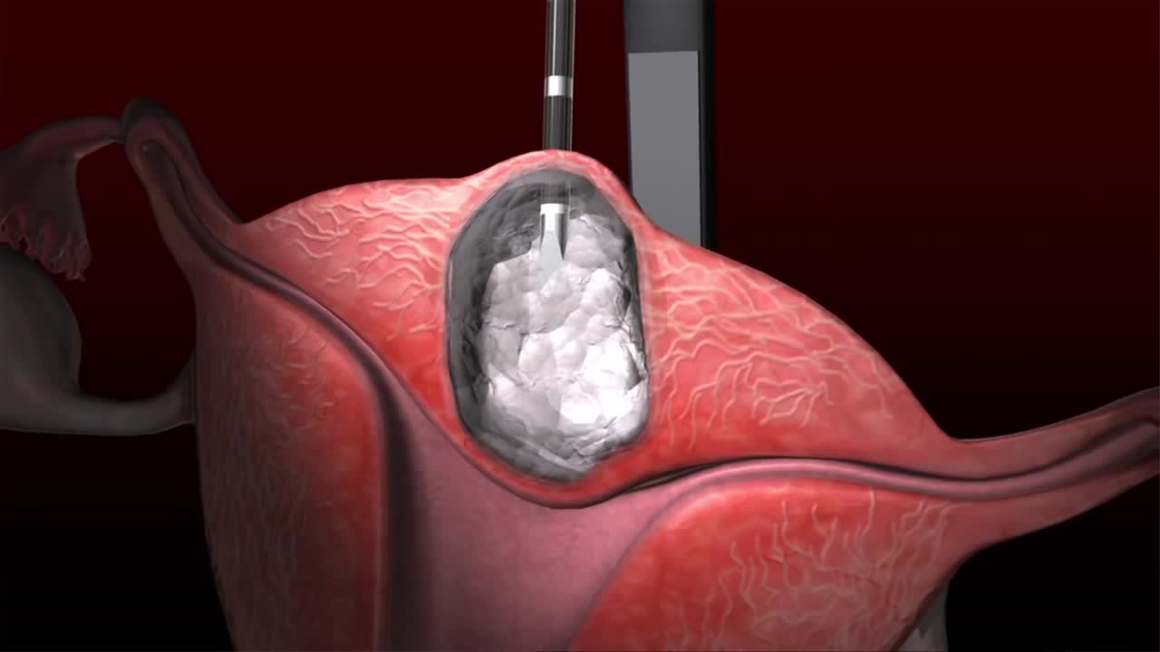 Acessa 治疗子宫肌瘤的优势