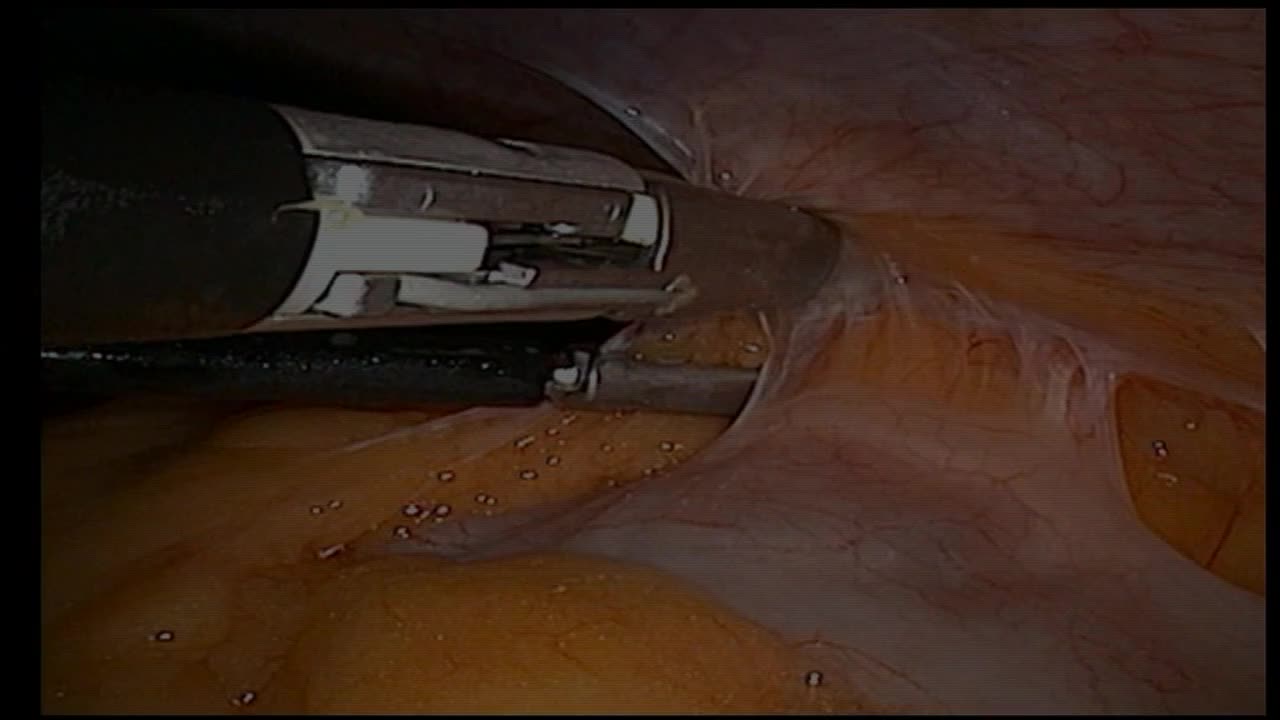 Is laparoscopic partial nephrectomy feasible in complex r..-