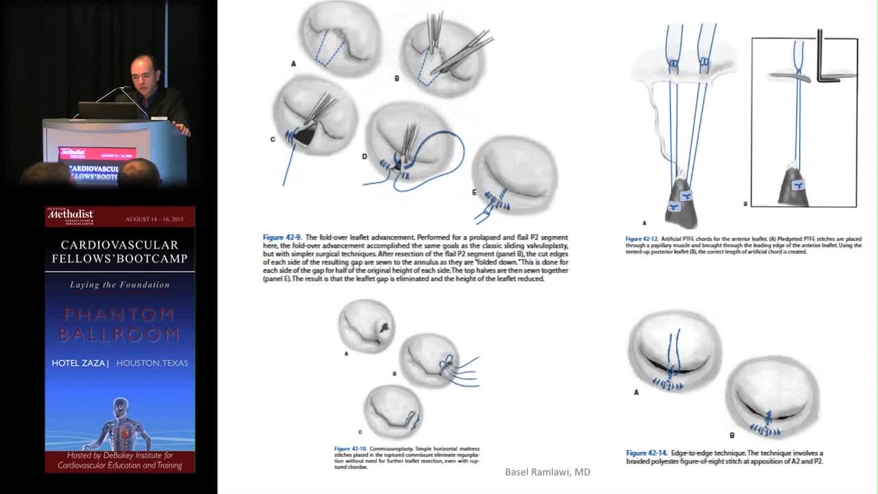 普外科医生教育课程-心瓣膜病手术 3