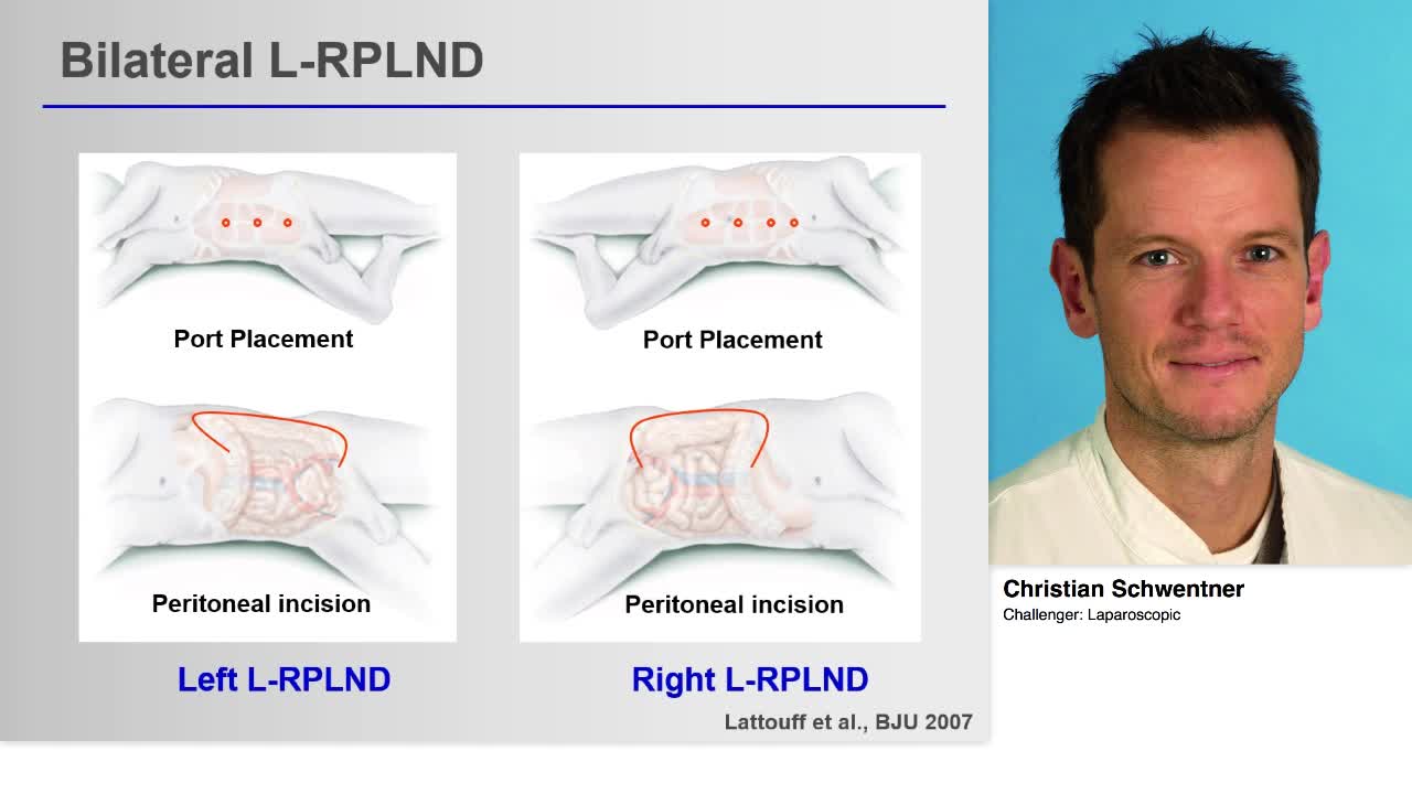 Challenger, Laparoscopic