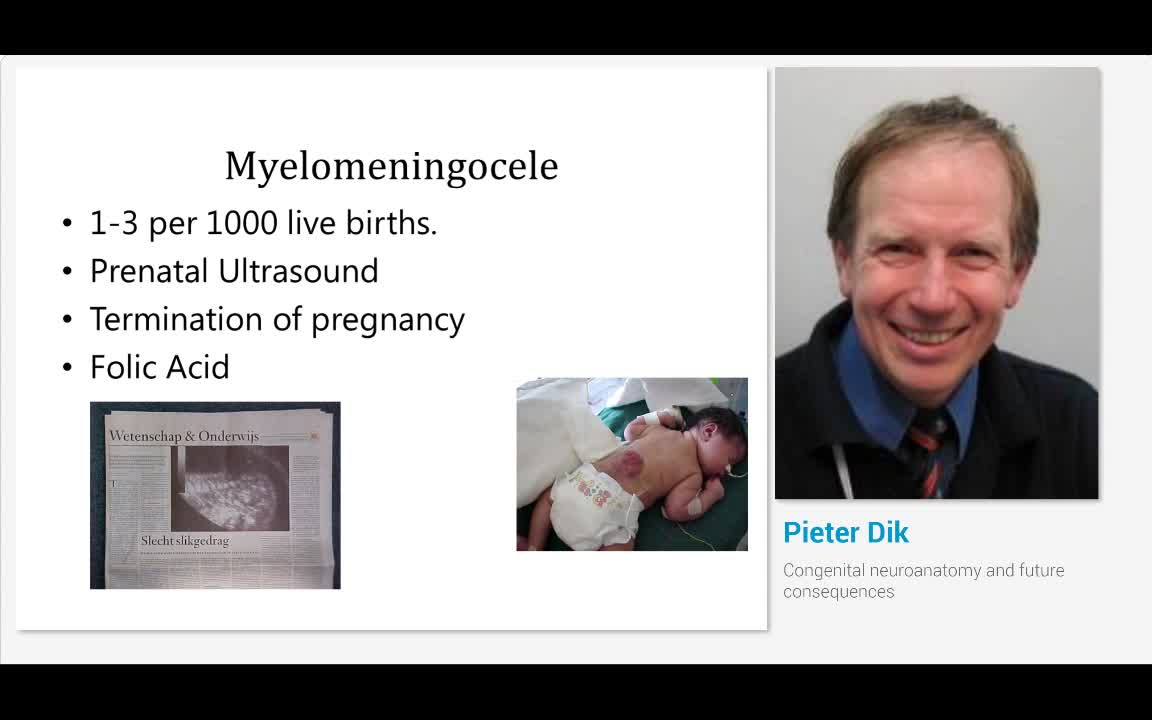 Congenital neuroanatomy and future consequences