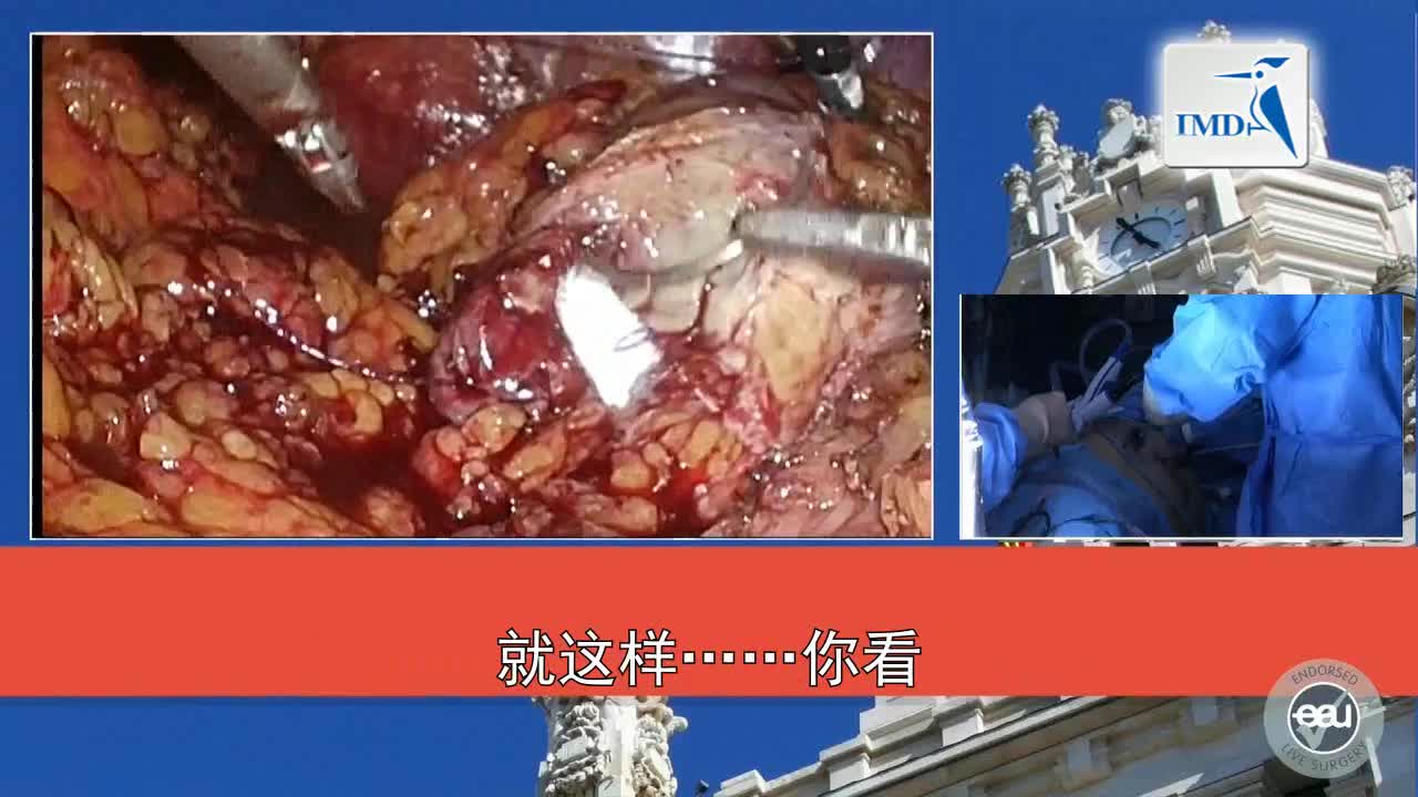 3D-HD腹腔镜肾部分切除术（4）