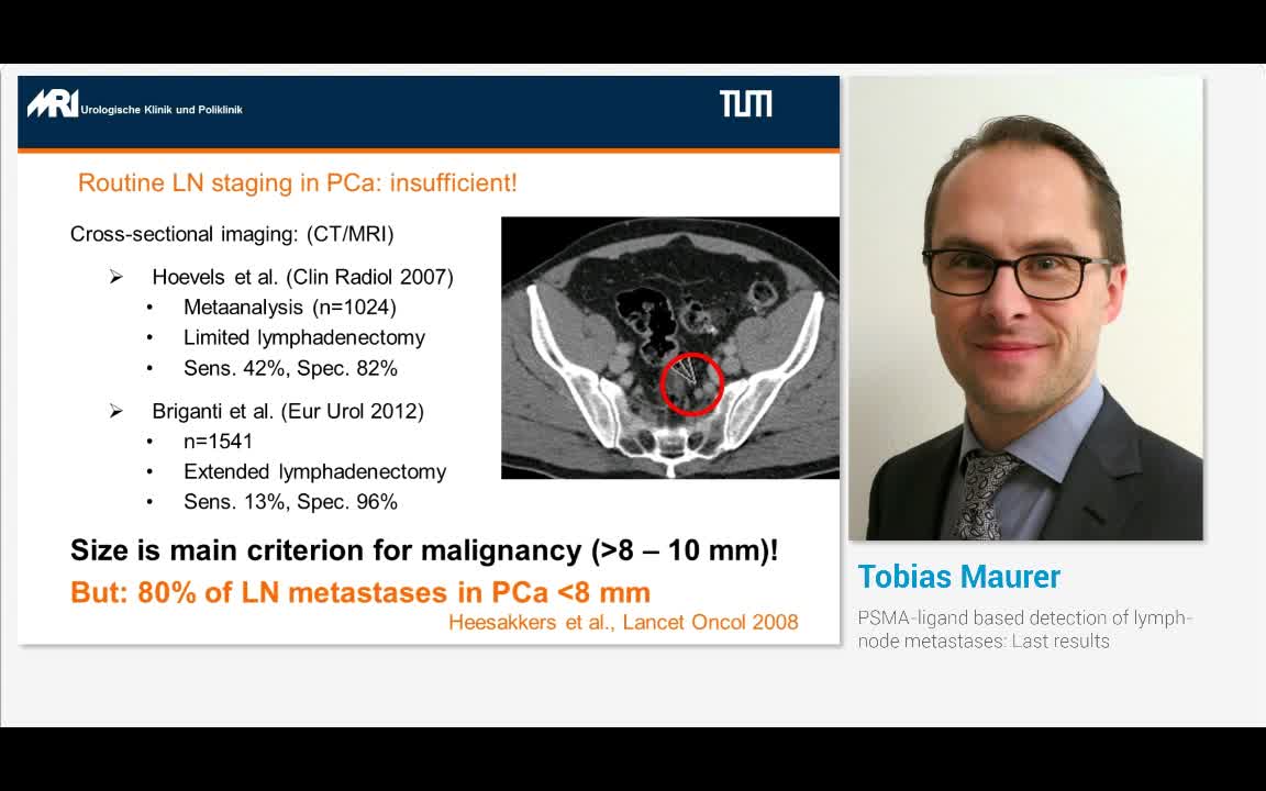 PSMA-ligand based detection of lymph-node metastases, Las..-