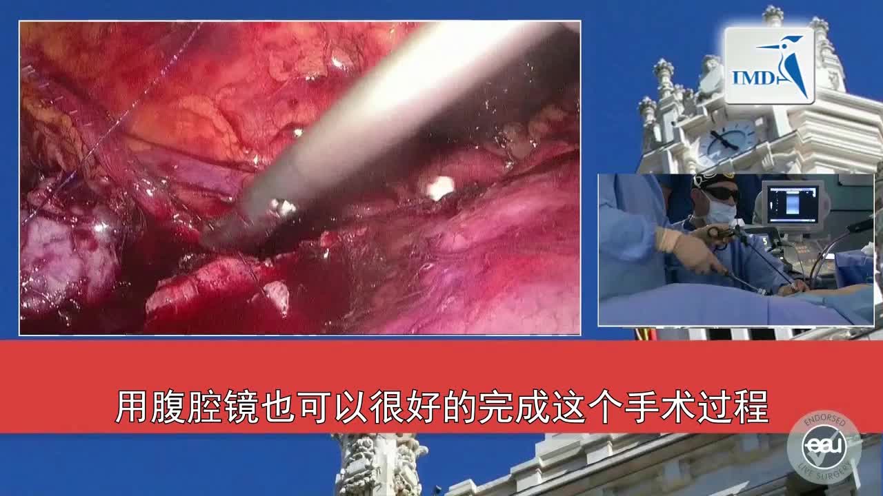 3D高清SPIES辅助腹腔镜部分肾切除术（4）