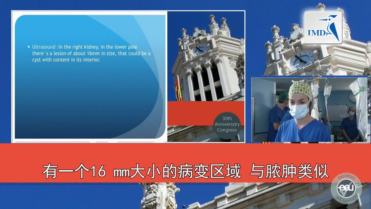 机器人辅助吲哚氰绿染色肾部分切除术（1）