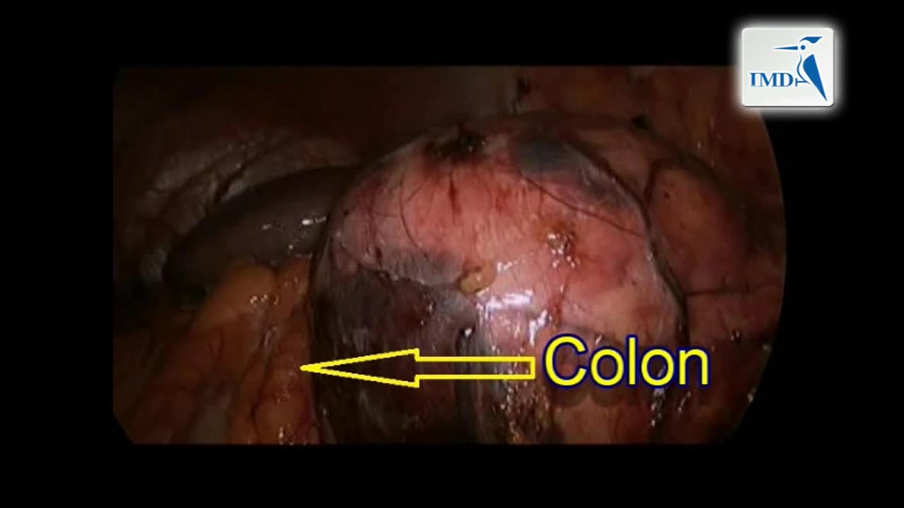 大型血管肌脂瘤手术中肾筋膜外部分肾切除