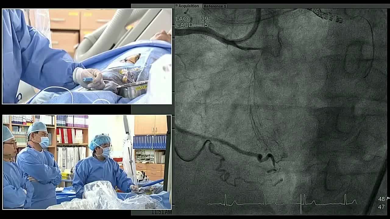 血管内手术现场案例一（6）