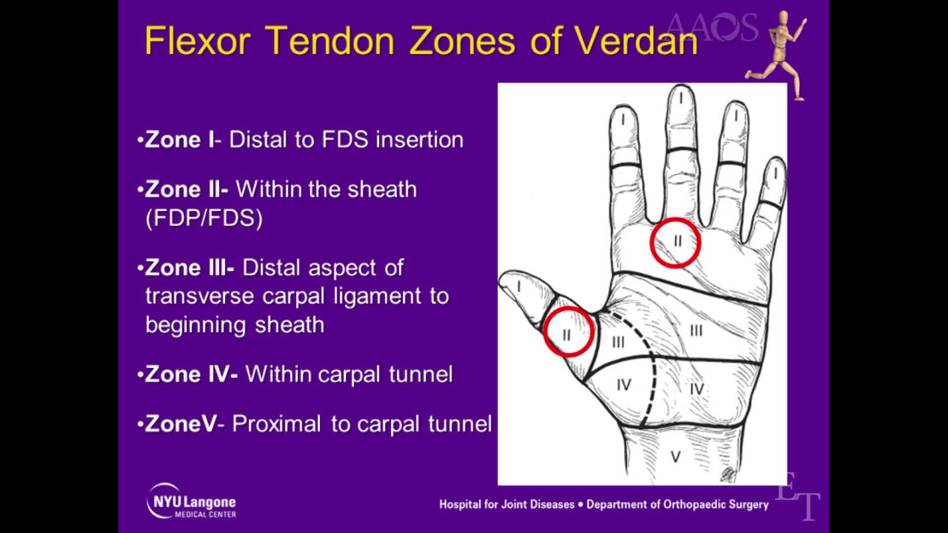 Zone 2 Flexor Tendon Injuries Primary Repair and SecondaryReconstruction