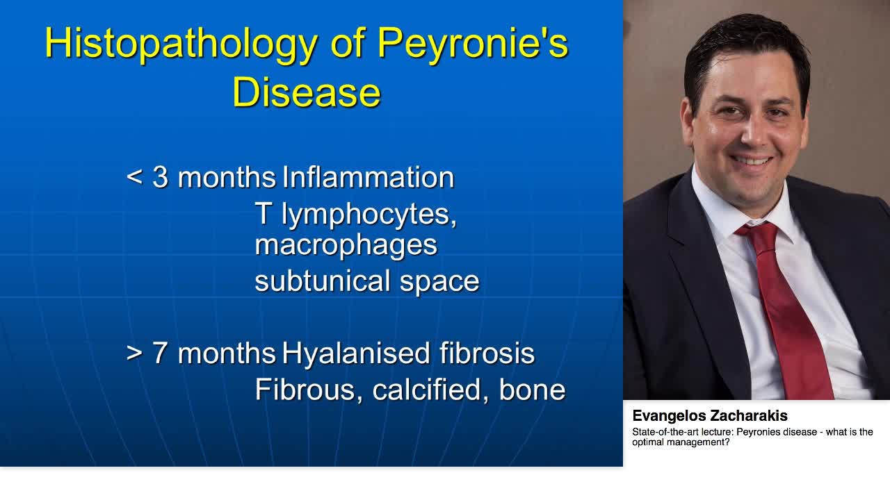 Peyronies disease - what is the optimal management.