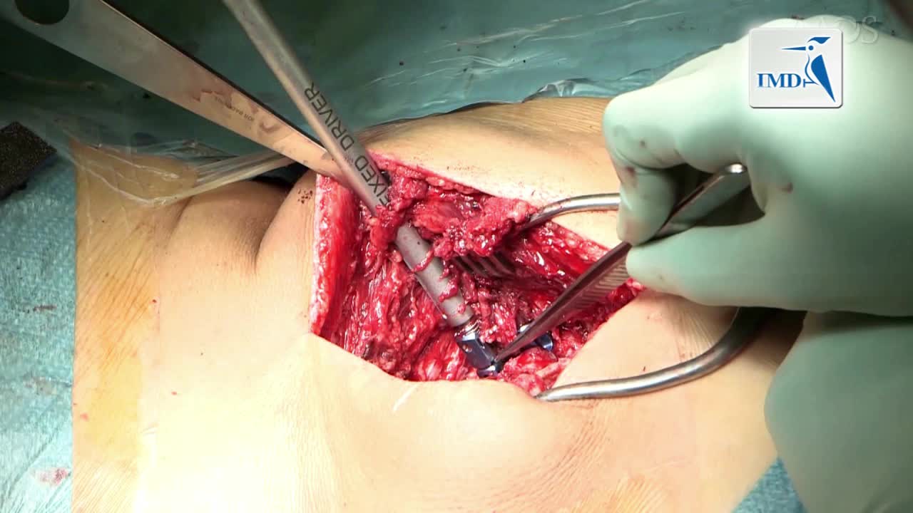 如何减轻严重不平衡狭窄性脊椎前移（3）