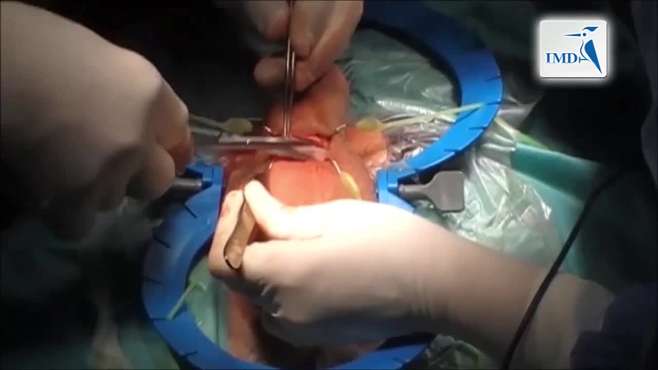 手术治疗阴茎勃起功能障碍和硬结症