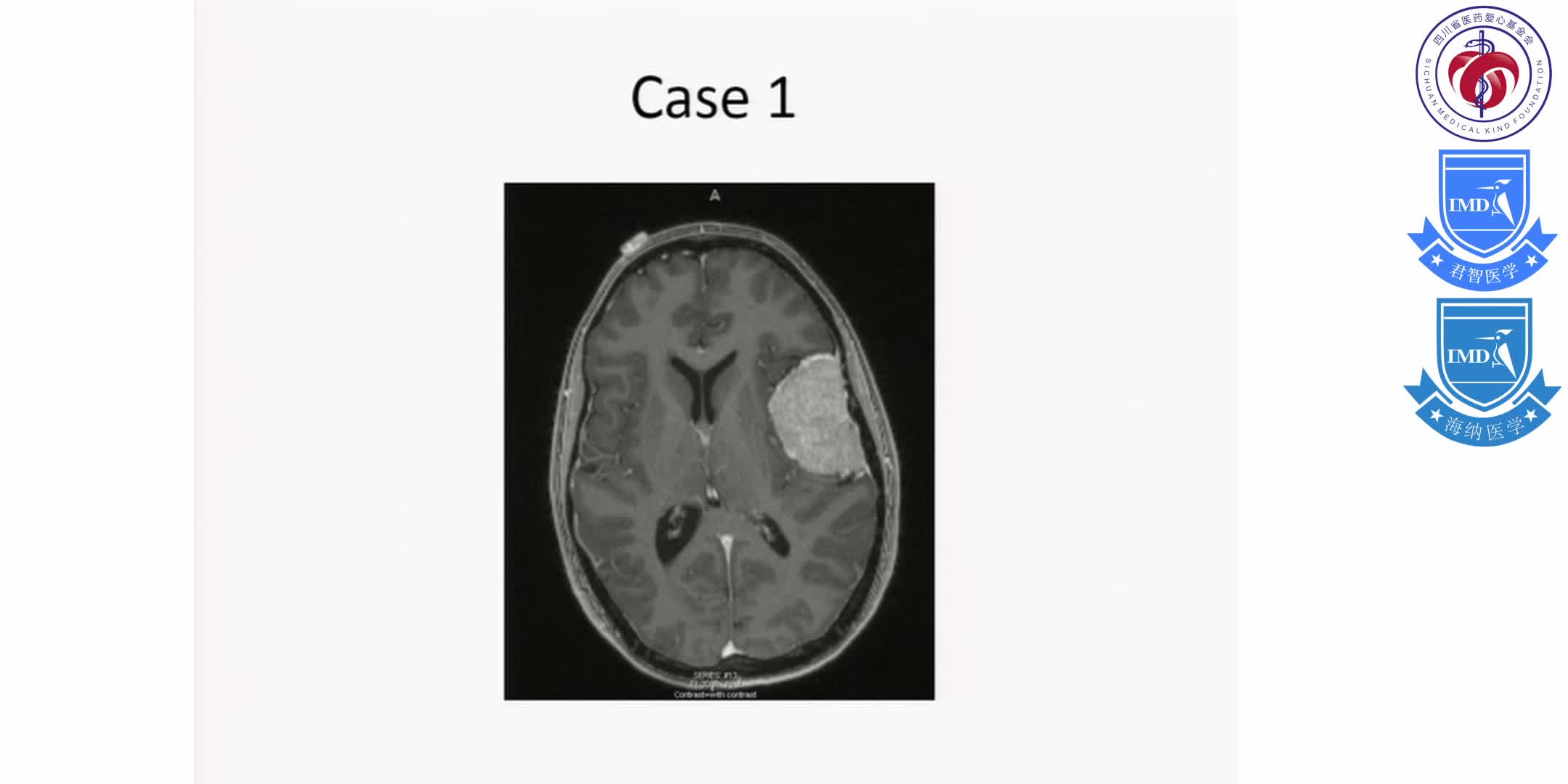 Initial Treatment, Including Scenarios Requiring Urgent and Multi-disciplinary Management for Primary Brain Tumors 11