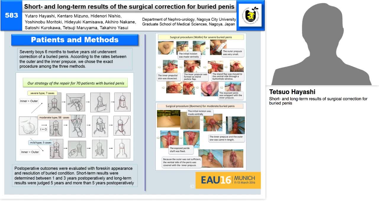 Short- and long-term results of surgical correction for b-