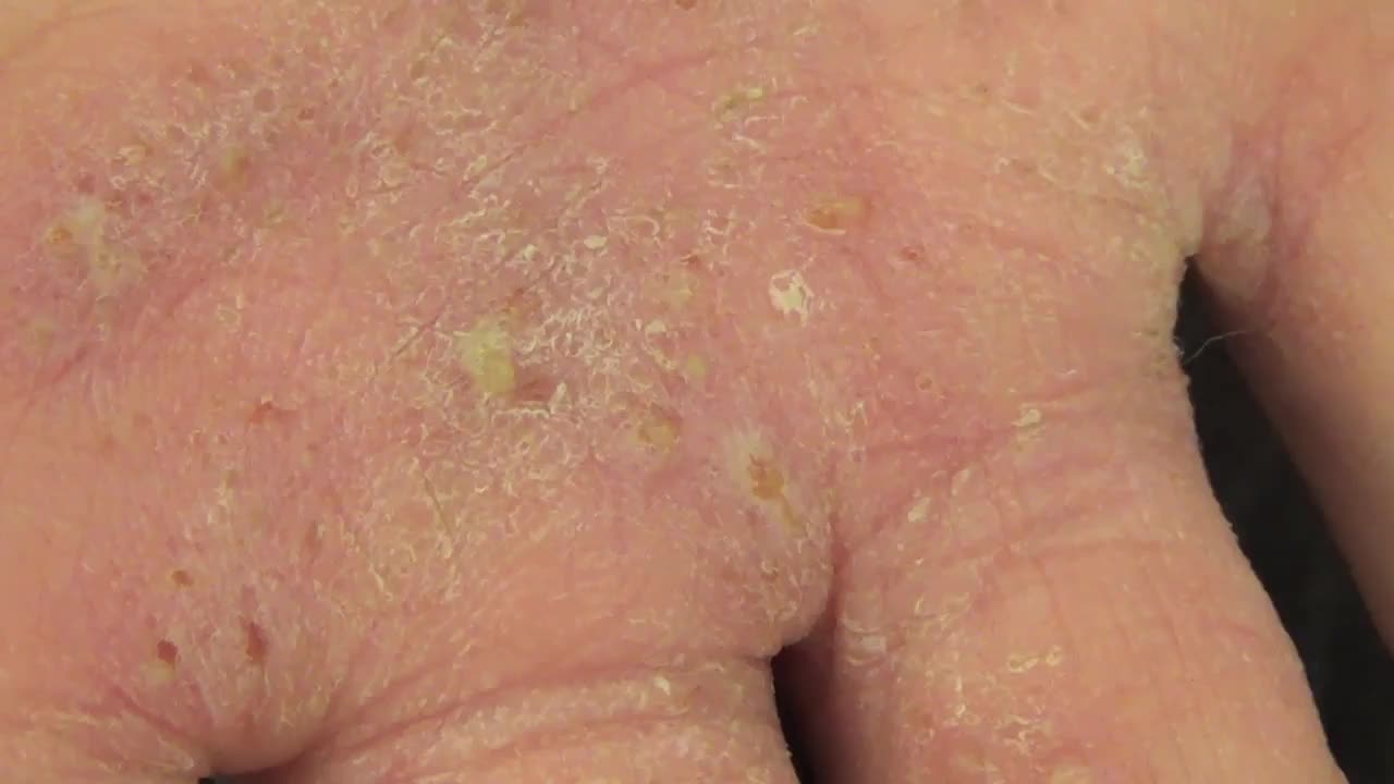 患有手掌水泡疮的13岁女孩