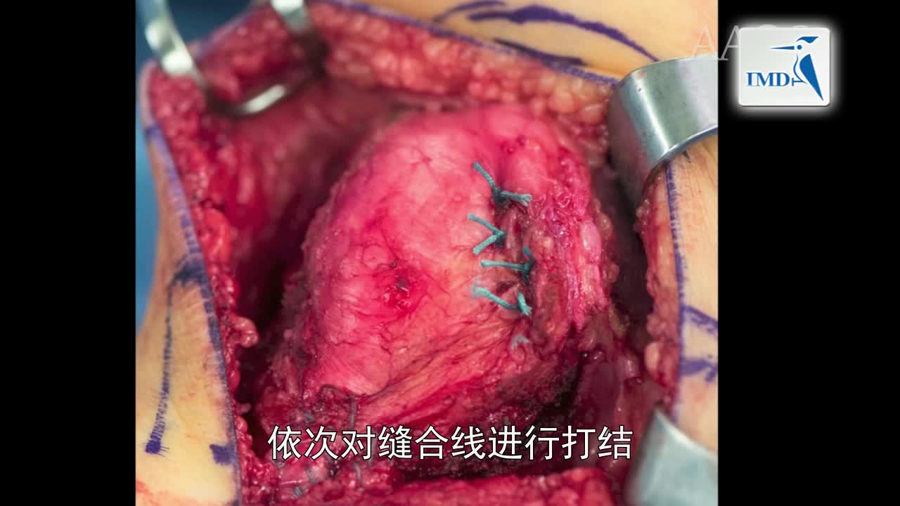 近侧调整近中髌腱移植手术（2）