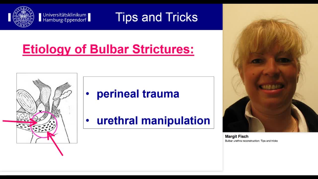 Bulbar urethra reconstruction, Tips and tricks