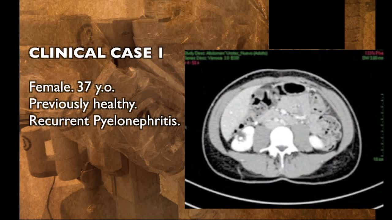 Challenging renal stone management during robotic pyelopl..-