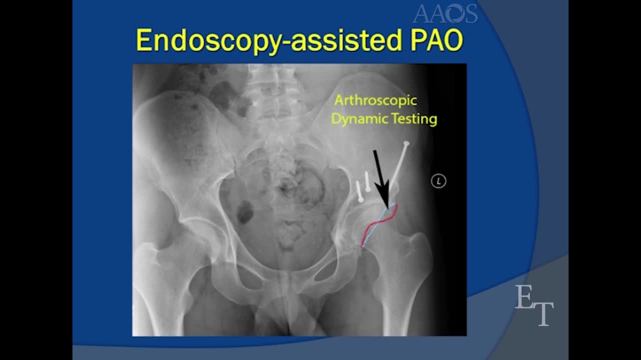 ENDOSCOPY-ASSISTEDPERI-ACETABULAR OSTEOTOMY